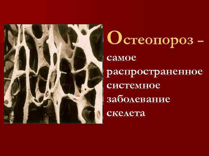 Остеопороз – самое распространенное системное заболевание скелета 