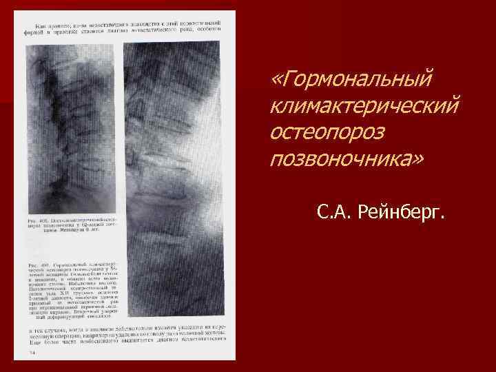  «Гормональный климактерический остеопороз позвоночника» С. А. Рейнберг. 