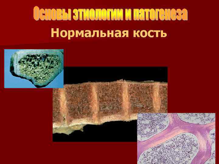 Нормальная кость 