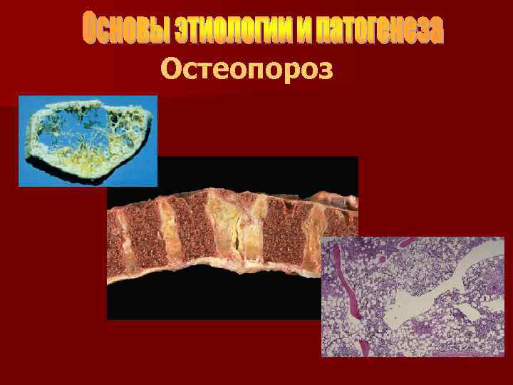 Остеопороз 