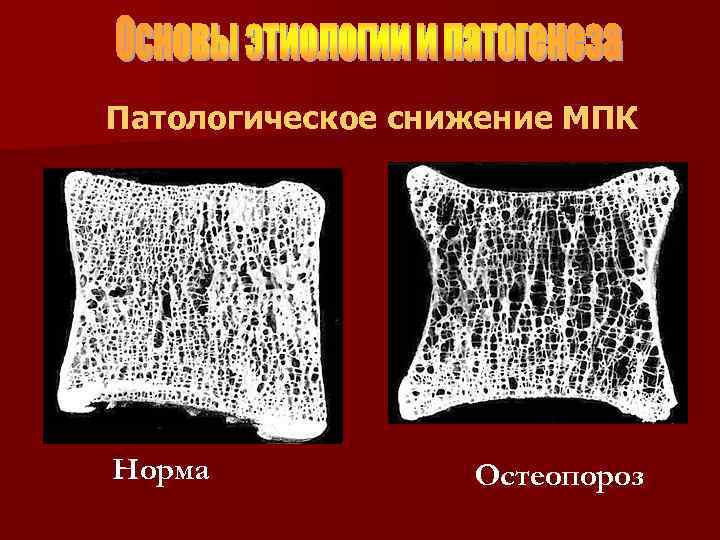Патологическое снижение МПК Норма Остеопороз 