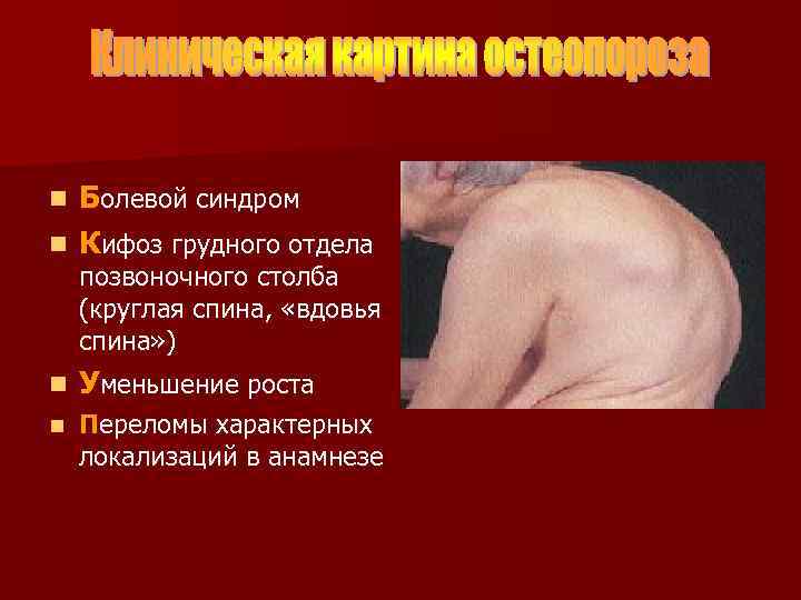 Болевой синдром n Кифоз грудного отдела n позвоночного столба (круглая спина, «вдовья спина» )