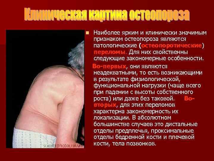 n Наиболее ярким и клинически значимым признаком остеопороза являются патологические (остеопоротические) переломы. Для них