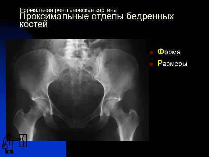 Нормальная рентгеновская картина Проксимальные отделы бедренных костей n n Форма Размеры 