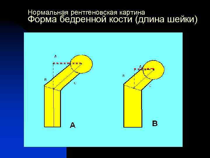 Нормальная рентгеновская картина Форма бедренной кости (длина шейки) 