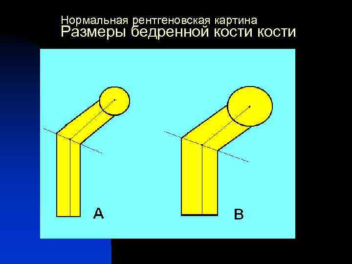 Нормальная рентгеновская картина Размеры бедренной кости 