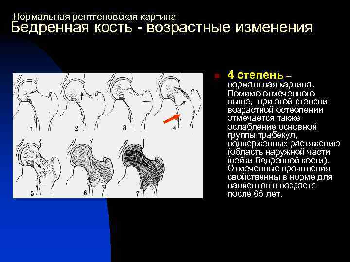 Нормальная рентгеновская картина Бедренная кость - возрастные изменения n 4 степень – нормальная картина.