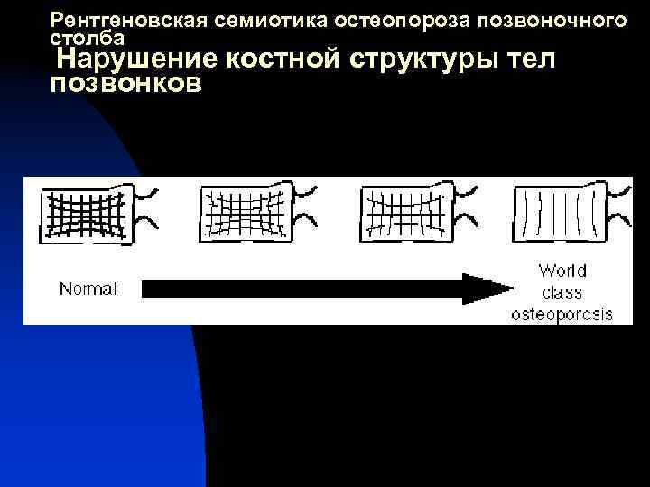 Рентгеновская семиотика остеопороза позвоночного столба Нарушение костной структуры тел позвонков 