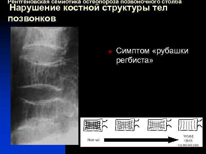 Рентгеновская семиотика остеопороза позвоночного столба Нарушение костной структуры тел позвонков n Симптом «рубашки регбиста»