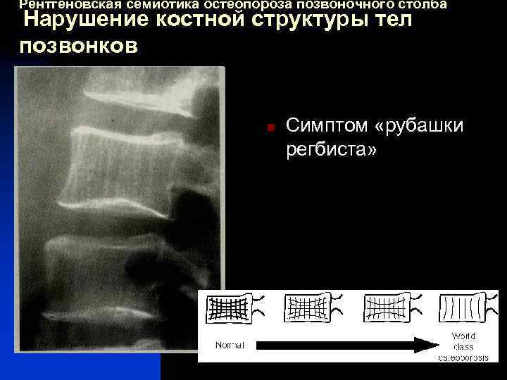 Рентгеновская семиотика остеопороза позвоночного столба Нарушение костной структуры тел позвонков n Симптом «рубашки регбиста»