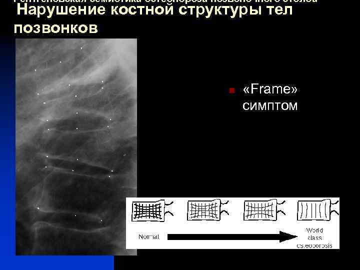Рентгеновская семиотика остеопороза позвоночного столба Нарушение костной структуры тел позвонков n «Frame» симптом 