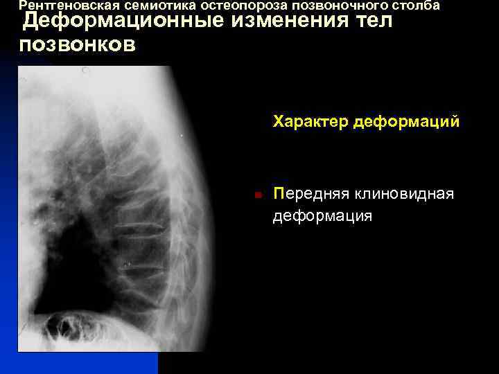 Рентгеновская семиотика остеопороза позвоночного столба Деформационные изменения тел позвонков Характер деформаций n Передняя клиновидная