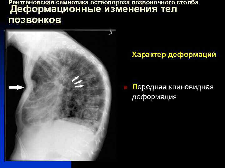 Рентгеновская семиотика остеопороза позвоночного столба Деформационные изменения тел позвонков Характер деформаций n Передняя клиновидная