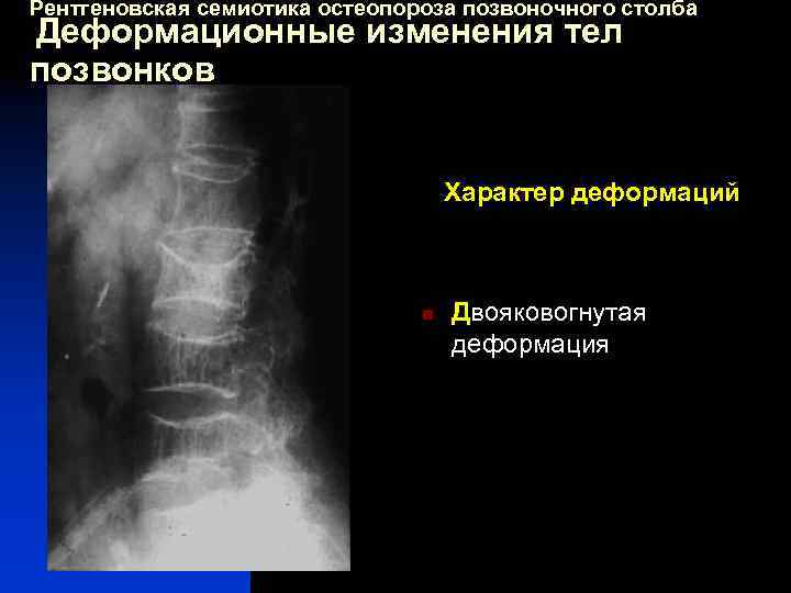 Рентгеновская семиотика остеопороза позвоночного столба Деформационные изменения тел позвонков Характер деформаций n Двояковогнутая деформация