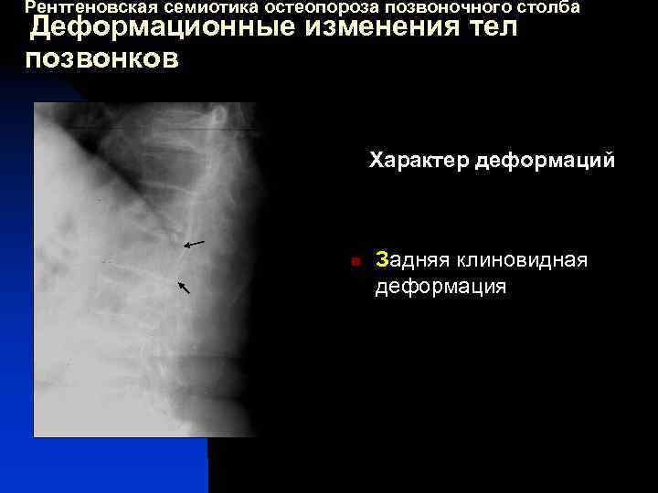 Рентгеновская семиотика остеопороза позвоночного столба Деформационные изменения тел позвонков Характер деформаций n Задняя клиновидная