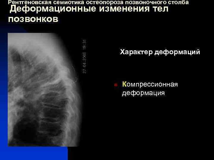 Рентгеновская семиотика остеопороза позвоночного столба Деформационные изменения тел позвонков Характер деформаций n Компрессионная деформация