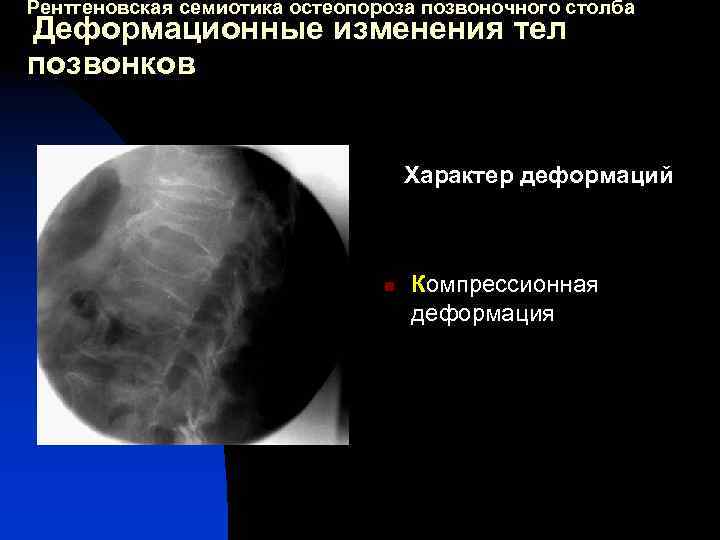 Рентгеновская семиотика остеопороза позвоночного столба Деформационные изменения тел позвонков Характер деформаций n Компрессионная деформация