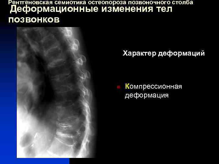 Рентгеновская семиотика остеопороза позвоночного столба Деформационные изменения тел позвонков Характер деформаций n Компрессионная деформация