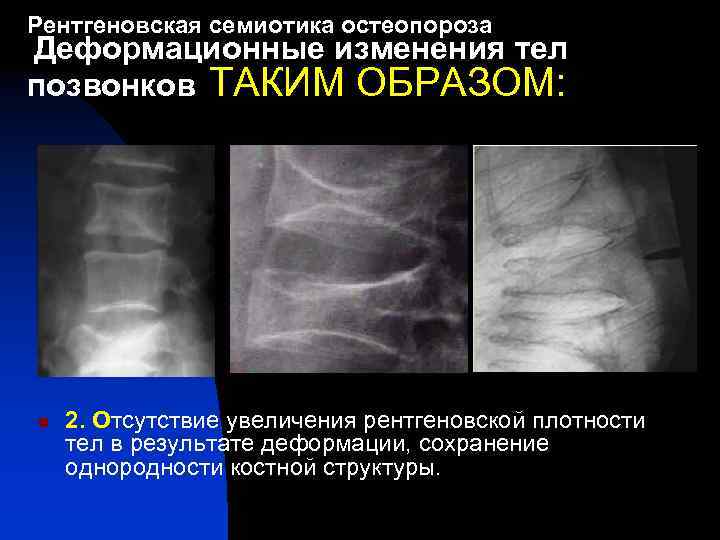 Рентгеновская семиотика остеопороза Деформационные изменения тел позвонков ТАКИМ ОБРАЗОМ: n 2. Отсутствие увеличения рентгеновской