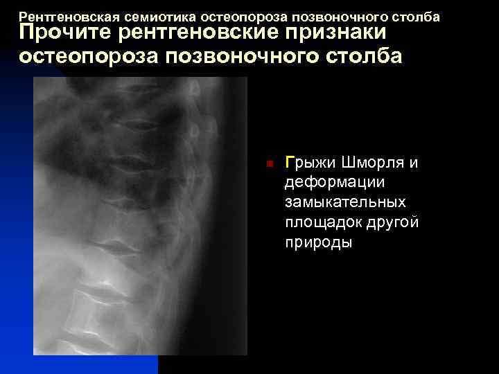 Рентгеновская семиотика остеопороза позвоночного столба Прочите рентгеновские признаки остеопороза позвоночного столба n Грыжи Шморля
