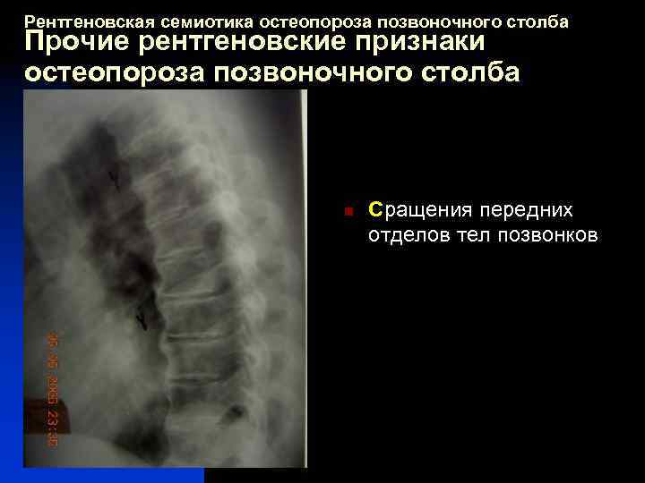 Рентгеновская семиотика остеопороза позвоночного столба Прочие рентгеновские признаки остеопороза позвоночного столба n Сращения передних