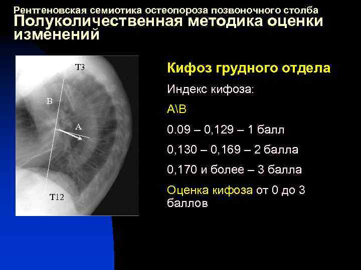 Степени кифоза грудного отдела позвоночника