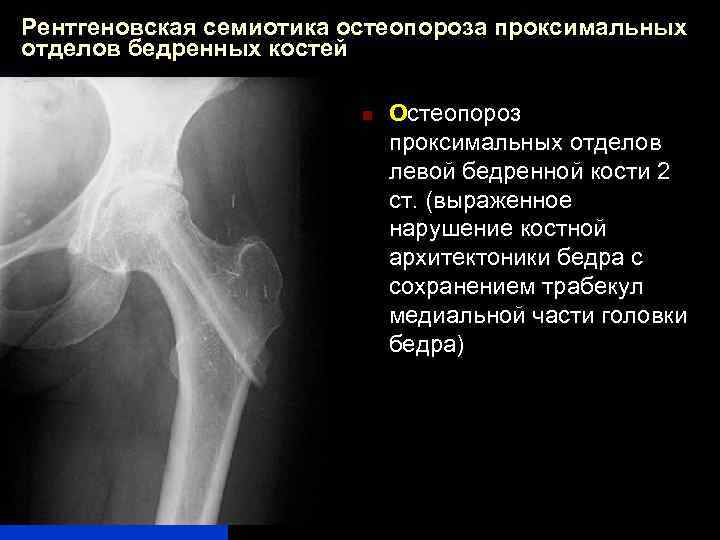 Рентгеновская семиотика остеопороза проксимальных отделов бедренных костей n Остеопороз проксимальных отделов левой бедренной кости