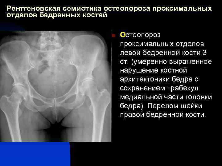 Рентгеновская семиотика остеопороза проксимальных отделов бедренных костей n Остеопороз проксимальных отделов левой бедренной кости