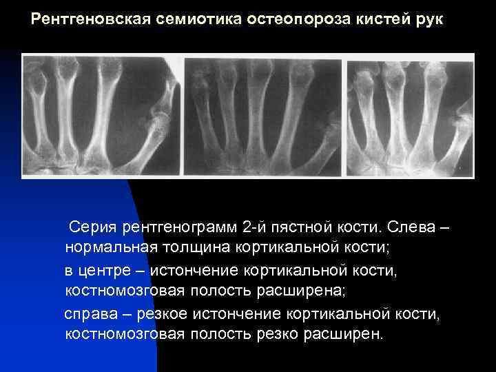 Рентгеновская семиотика остеопороза кистей рук Серия рентгенограмм 2 -й пястной кости. Слева – нормальная