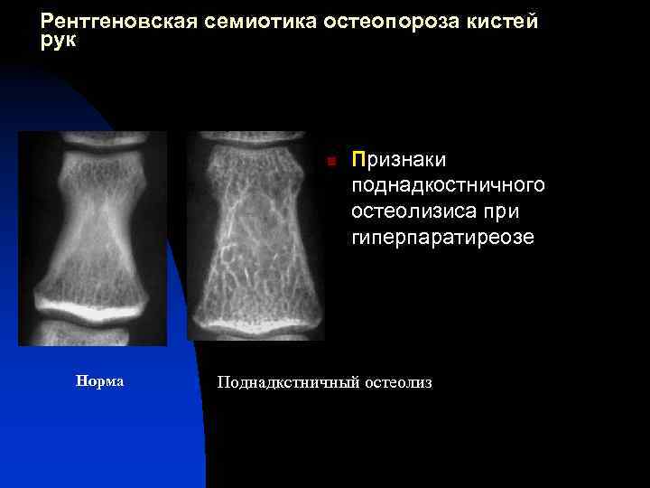 Пятнисто хлопьевидный рисунок костной структуры при деформирующей остеодистрофии педжета характерен