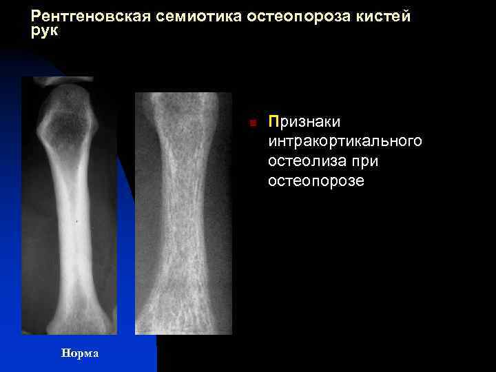 Рентгеновская семиотика остеопороза кистей рук n Норма Признаки интракортикального остеолиза при остеопорозе 