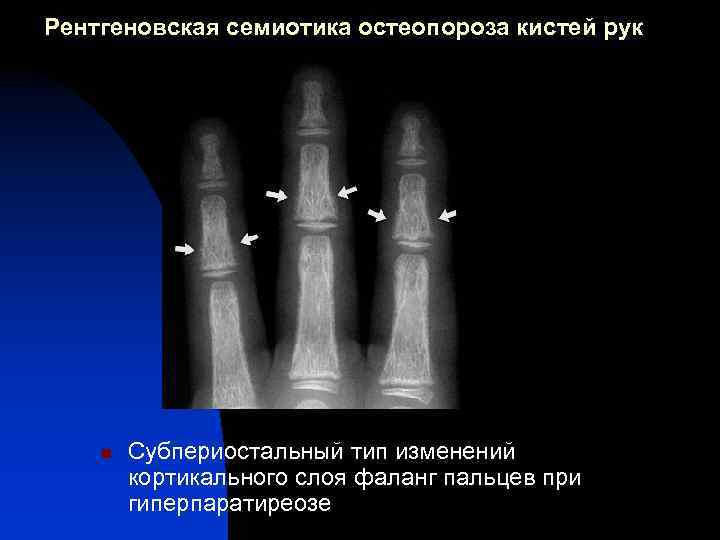Рентгеновская семиотика остеопороза кистей рук n Субпериостальный тип изменений кортикального слоя фаланг пальцев при