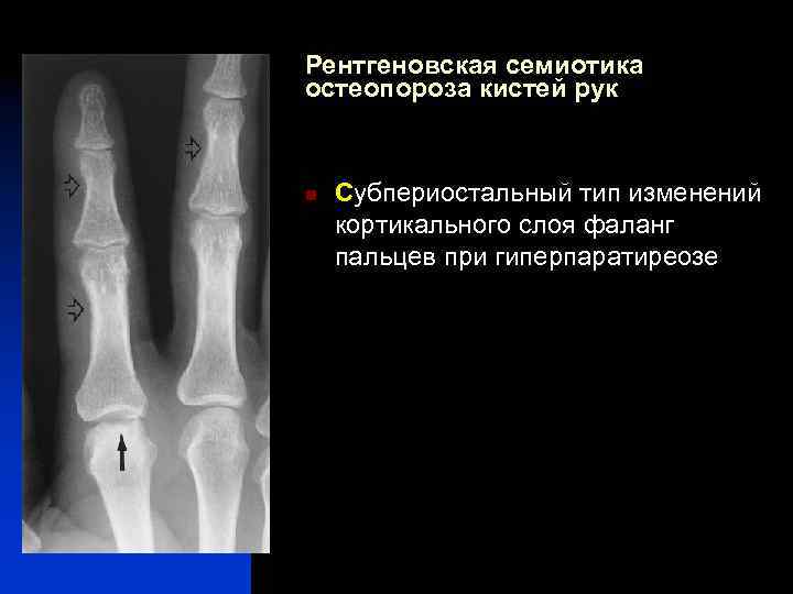 Рентгеновская семиотика остеопороза кистей рук n Субпериостальный тип изменений кортикального слоя фаланг пальцев при