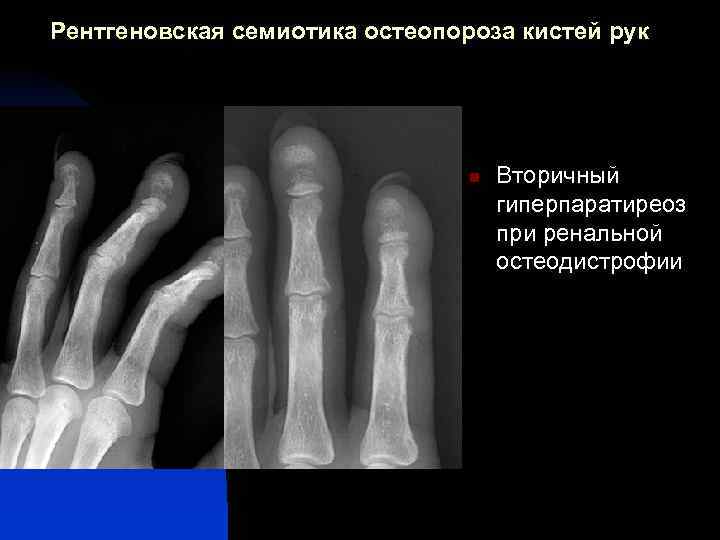 Рентгеновская семиотика остеопороза кистей рук n Вторичный гиперпаратиреоз при ренальной остеодистрофии 