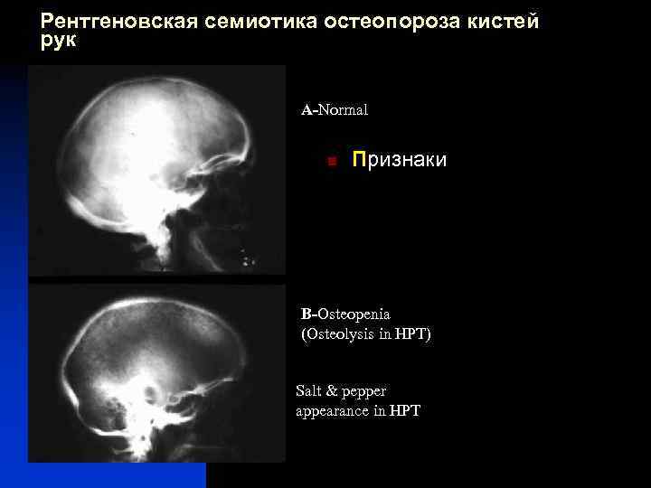 Рентгеновская семиотика остеопороза кистей рук A-Normal n Признаки B-Osteopenia (Osteolysis in HPT) Salt &