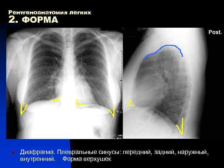 Рентгеноанатомия легких 2. ФОРМА n Диафрагма. Плевральные синусы: передний, задний, наружный, внутренний. Форма верхушек