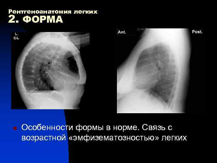 Рентгеноанатомия легких 2. ФОРМА n Особенности формы в норме. Связь с возрастной «эмфизематозностью» легких
