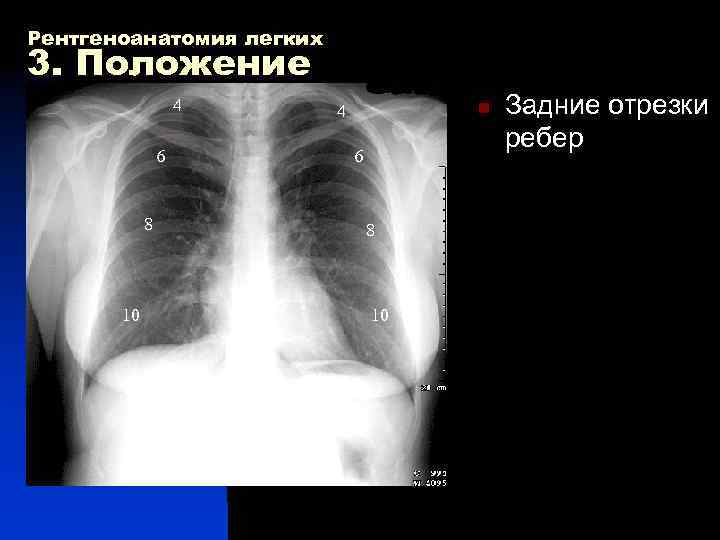 Рентгеноанатомия легких 3. Положение 4 4 n Задние отрезки ребер 6 8 10 10