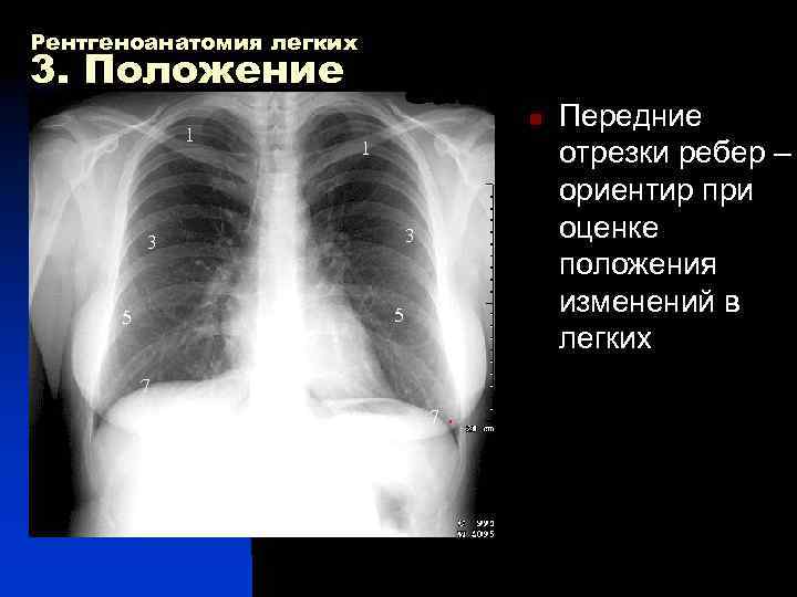 Рентгеноанатомия легких 3. Положение n Передние 1 отрезки ребер – ориентир при 3 оценке