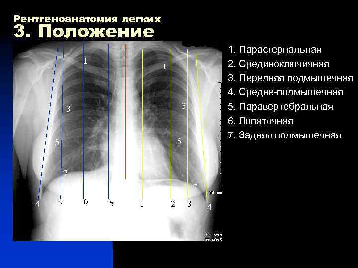 Рентгеноанатомия легких 3. Положение 1. Парастернальная 1 2. Срединоключичная 1 3. Передняя подмышечная 4.