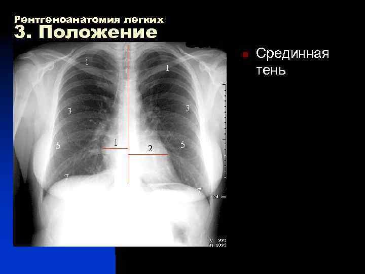Рентгеноанатомия легких 3. Положение n Срединная 1 тень 3 5 1 5 2 7