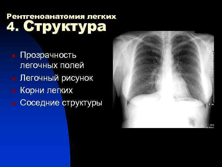 Рентгеноанатомия легких 4. Структура n Прозрачность легочных полей n Легочный рисунок n Корни легких