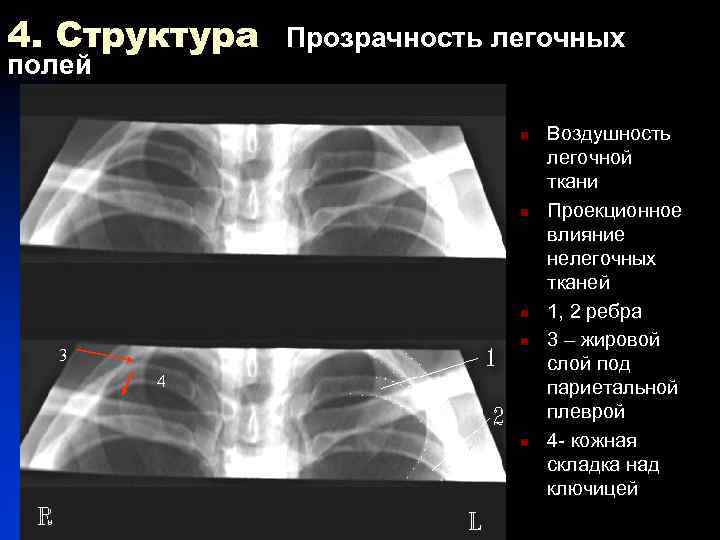 Легочный рисунок тяжистый