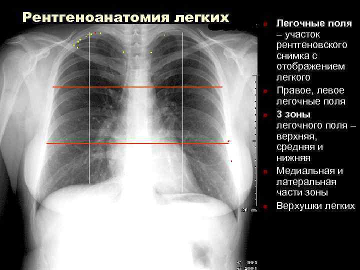 Рентгеноанатомия легких n Легочные поля – участок рентгеновского снимка с отображением легкого n Правое,