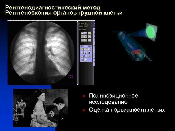 Рентгенодиагностический метод Рентгеноскопия органов грудной клетки n n Полипозиционное исследование Оценка подвижности легких 
