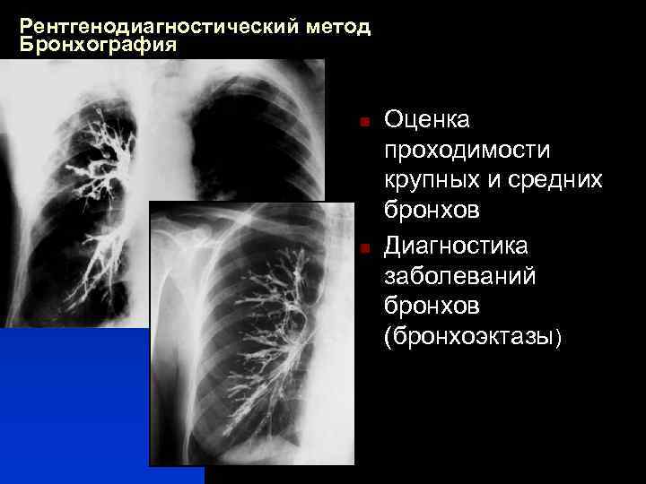 Рентгенодиагностический метод Бронхография n n Оценка проходимости крупных и средних бронхов Диагностика заболеваний бронхов