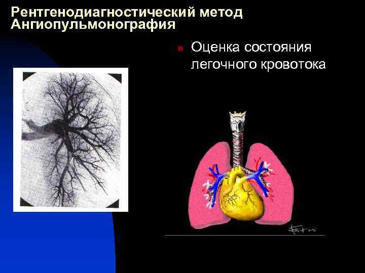 Рентгенодиагностический метод Ангиопульмонография n Оценка состояния легочного кровотока 
