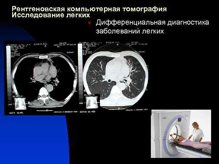 Рентгеновская компьютерная томография Исследование легких n Дифференциальная диагностика заболеваний легких 