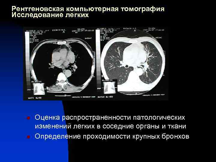 Рентгеновская компьютерная томография Исследование легких n n Оценка распространенности патологических изменений легких в соседние