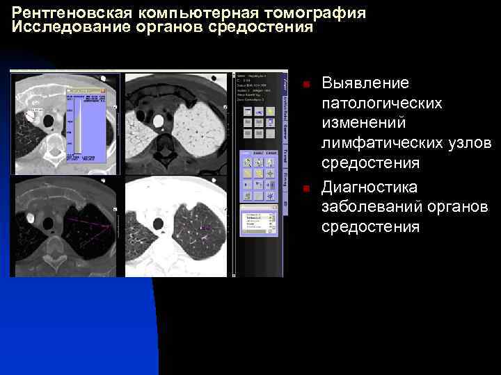 Рентгеновская компьютерная томография Исследование органов средостения n n Выявление патологических изменений лимфатических узлов средостения